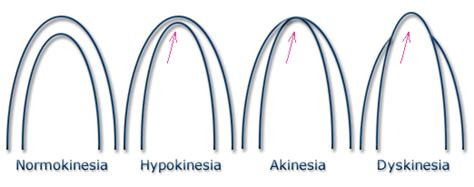 global hypokinesia of lv in hindi